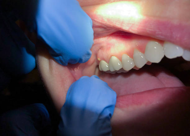 Best Emergency Tooth Extraction in Midtown, TN