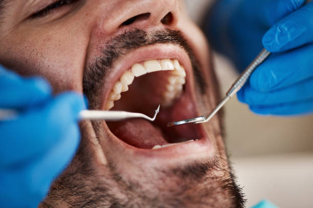 Best Emergency Tooth Extraction in Midtown, TN
