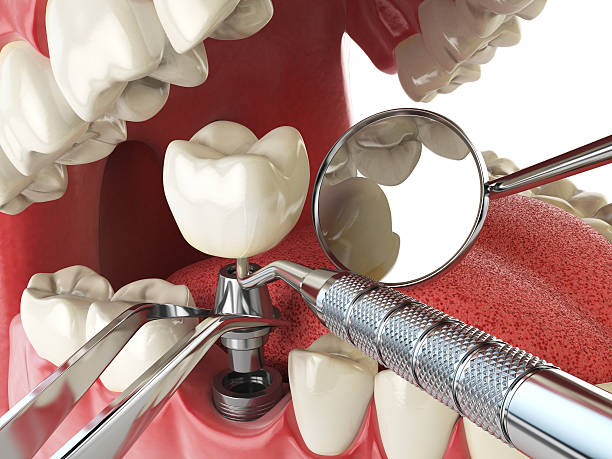 Best Emergency Tooth Extraction in Midtown, TN