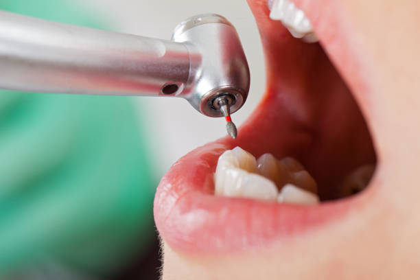 Best Emergency Wisdom Teeth Removal in Midtown, TN